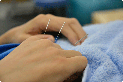 鍼治療を行っている写真画像